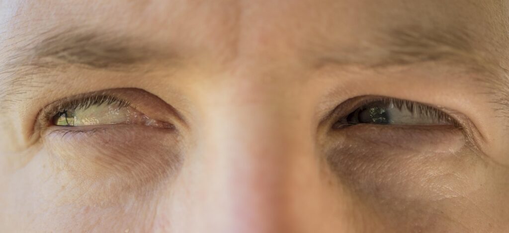 Orzaiolo sull’occhio, il rimedio della nonna che funziona più dei farmaci: provalo